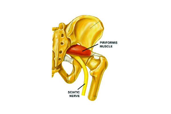 Piriformis Syndrome – A Real Pain in the Butt